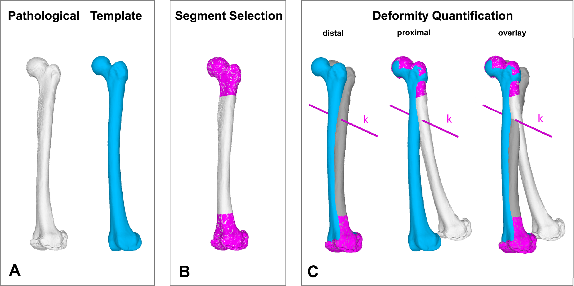 Dome Versus Single cut Osteotomies For Correction Of Long Bone Deformities technical Considerations Scientific Reports Dome Versus Single cut Osteotomies For Correction Of Long Bone Deformities technical Considerations Scientific Reports